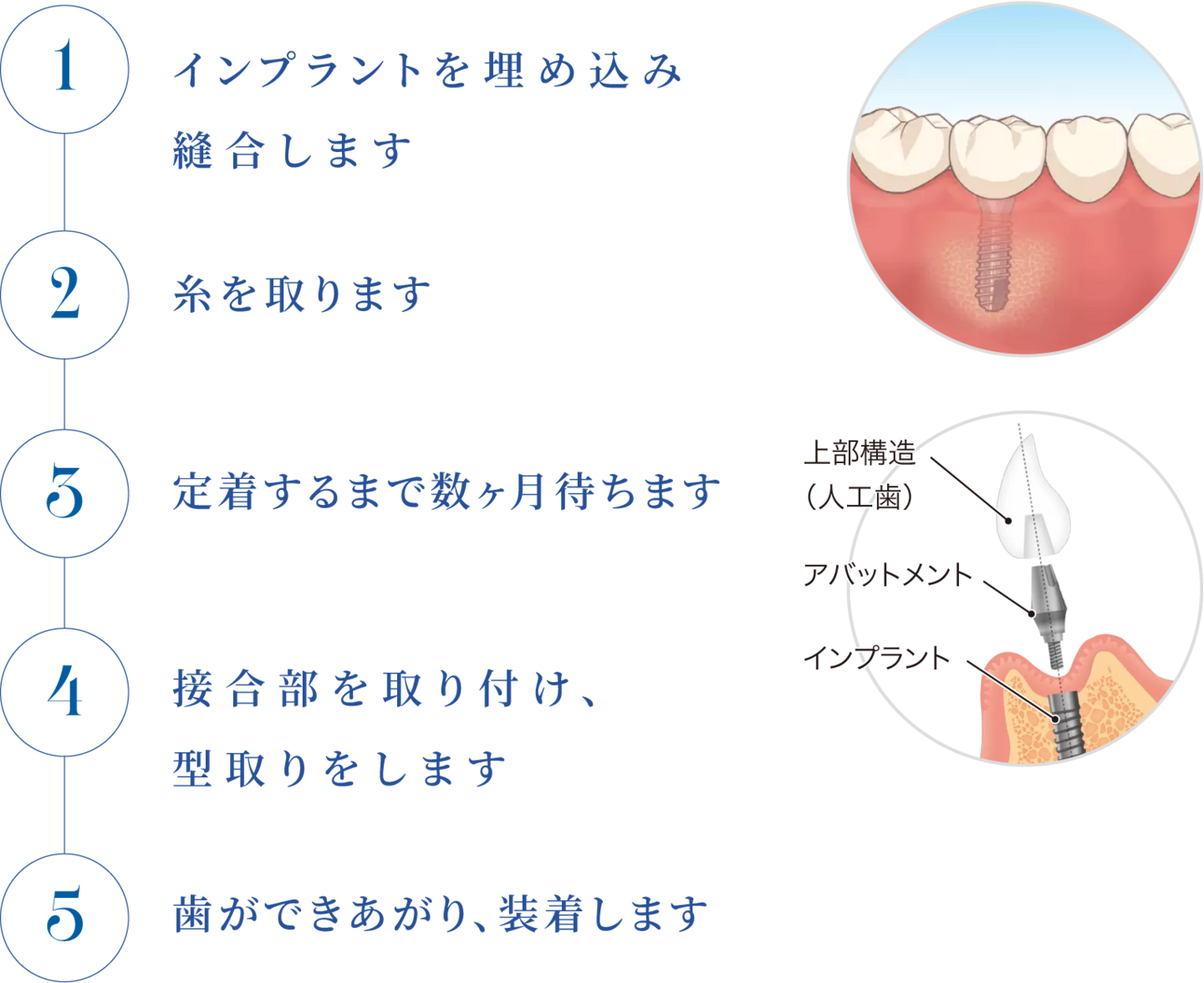 インプラント治療の流れ